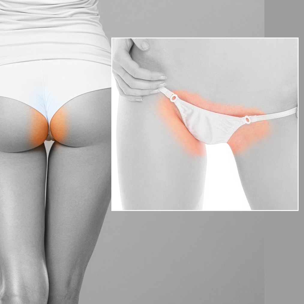 Ladies Full Brazilian Bikini • Laser Hair Removal