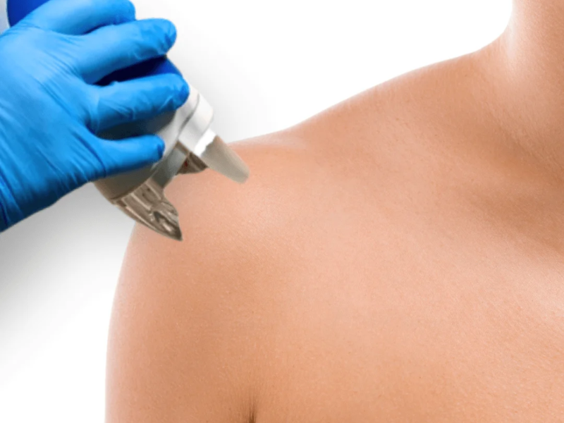 Bikini Line / Línea del Bikini laser hair removal at Barbie Beauty Care
