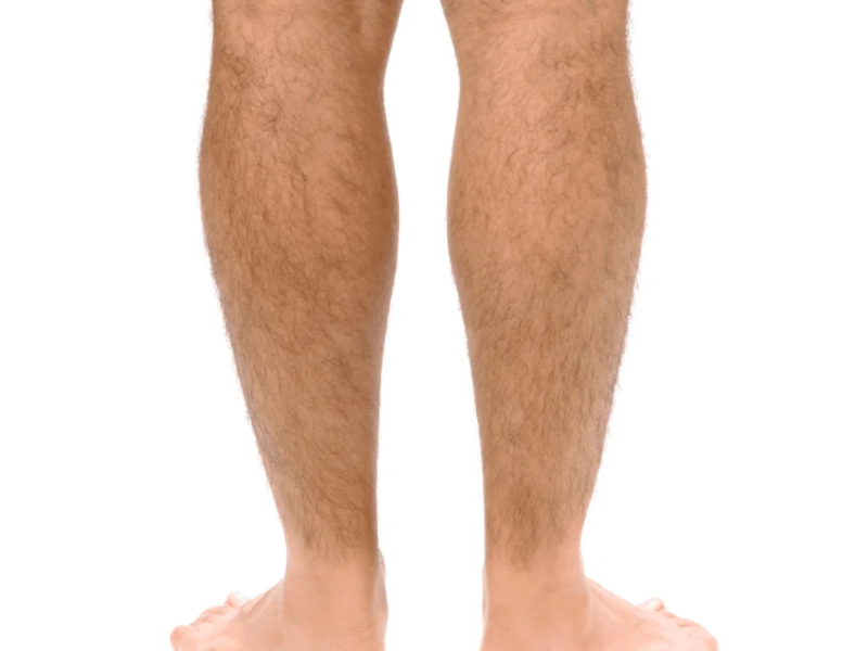 Upper Lip / Bozo laser hair removal at Barbie Beauty Care
