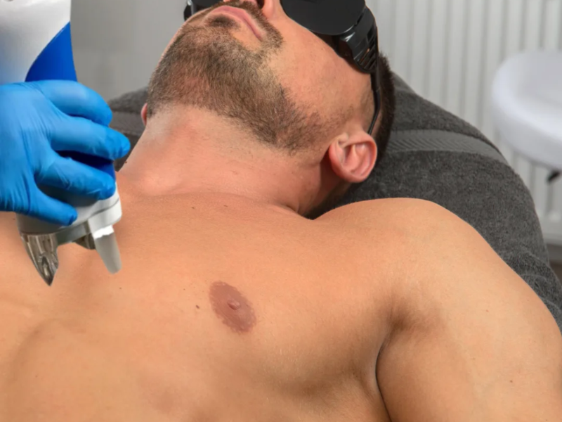 Men Beard / Barba Caballero laser hair removal at Barbie Beauty Care