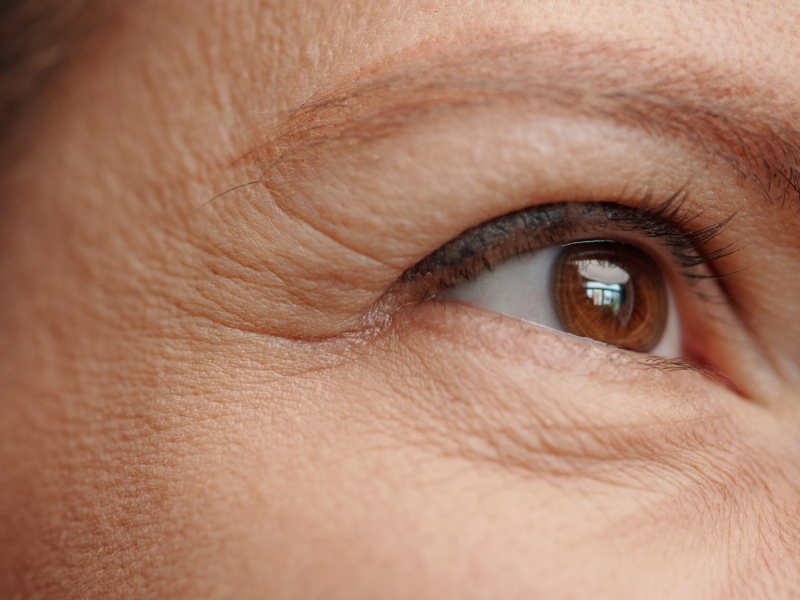 Wrinkles and Sagging Consultation