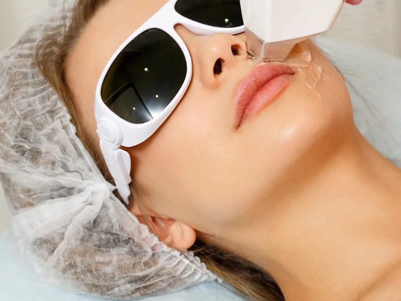 Unibrow / Entrecejo laser hair removal at Barbie Beauty Care