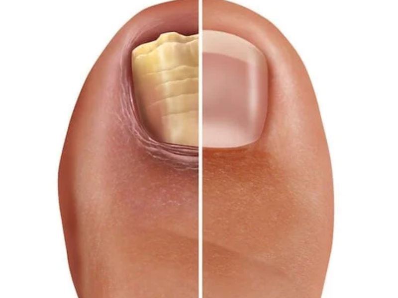 Nail Fungus Splendor X laser treatment