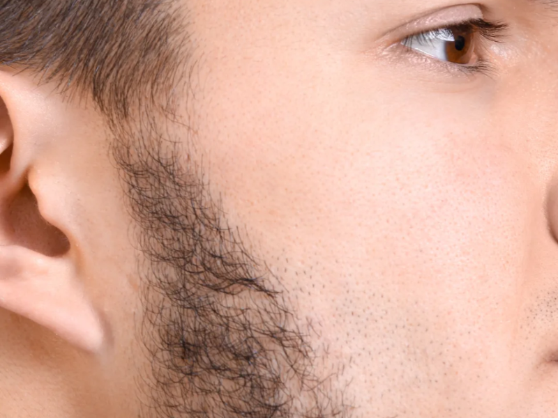 Shoulders / Hombros laser hair removal at Barbie Beauty Care