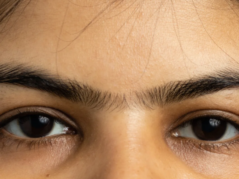Sideburn / Patillas laser hair removal at Barbie Beauty Care
