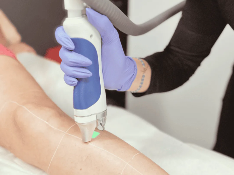 Full Face / Cara Completa laser hair removal at Barbie Beauty Care