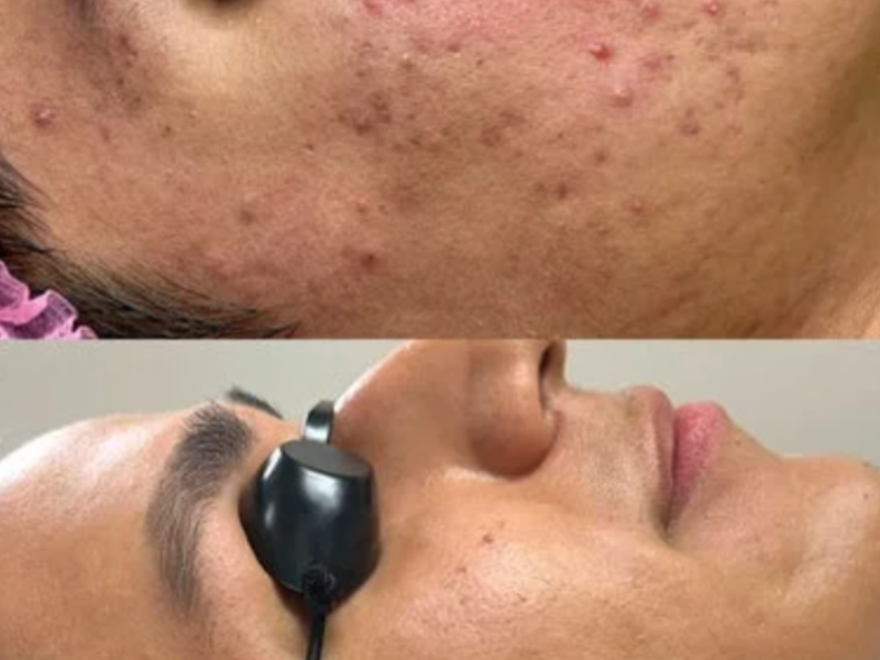 Acne Bootcamp Consultation