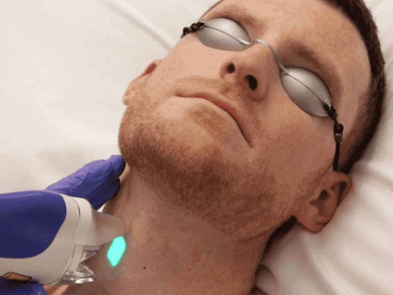 Knuckles / Nudillos laser hair removal at Barbie Beauty Care