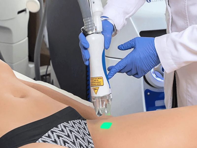 Lower Back / Espalda Baja laser hair removal at Barbie Beauty Care